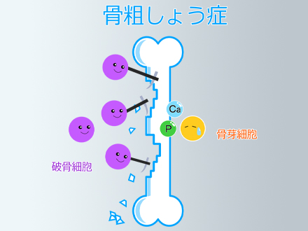 骨粗鬆症（こつそしょうしょう）とは