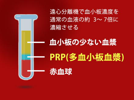 PRP療法とは